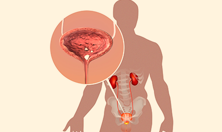 방광 속 작은 결석을 확대한 원과 남성 요로 구조 그림