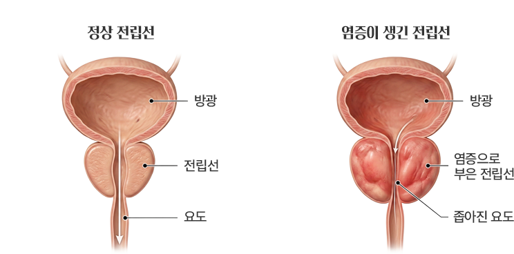 정상 전립선과 염증으로 부은 전립선·좁아진 요도를 비교한 도식