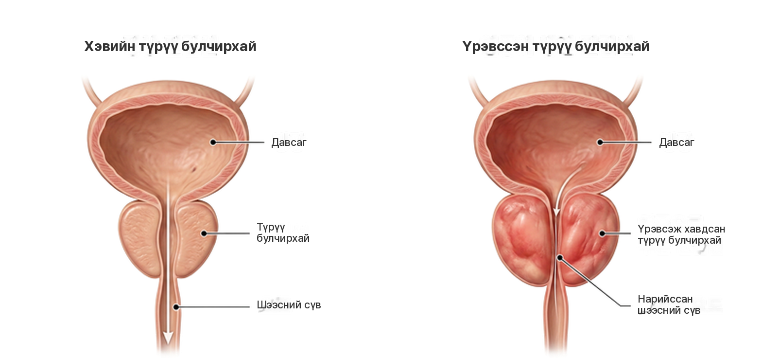 Хэвийн түрүү булчирхайг үрэвсэж хавдсан түрүү булчирхай, нарийссан шээсний сүвтэй харьцуулсан зураг