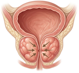 커진 전립선이 요도를 양쪽에서 압박하는 모습을 화살표로 표시한 도식